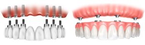 Имплантация зубов по технологии All-on-4 и All-on-6