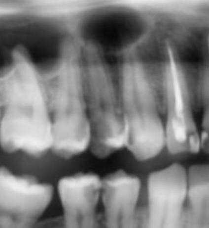 Переведи на русский язык: Endodontické ošetření + fotokompozitní dosavba + zirkonoxidová korunka - zub 14