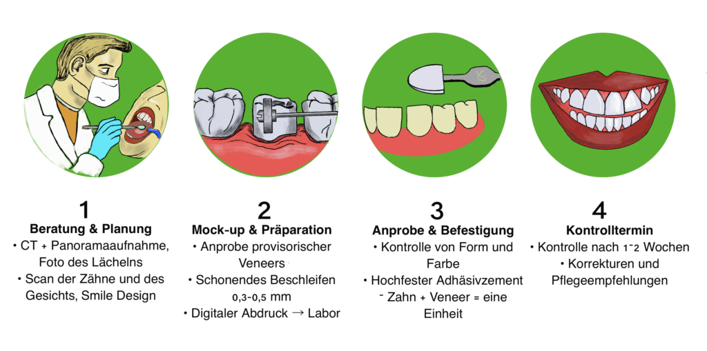 Veneers