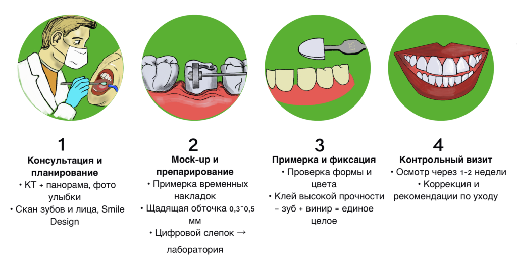 Установка виниров