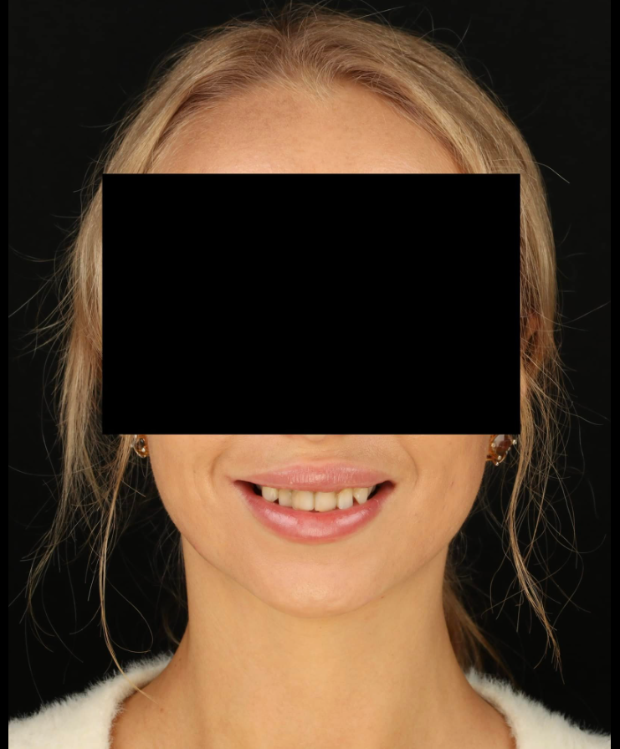 Циркониевые коронки