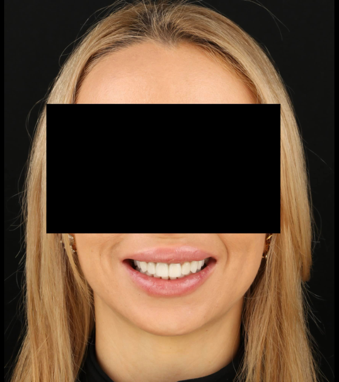 Циркониевые коронки