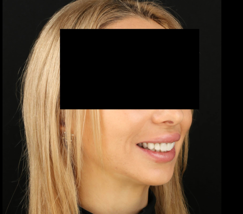 Циркониевые коронки