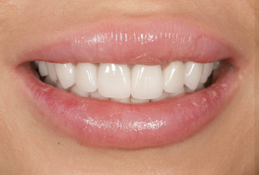 Циркониевые коронки