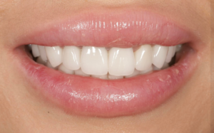 Циркониевые коронки