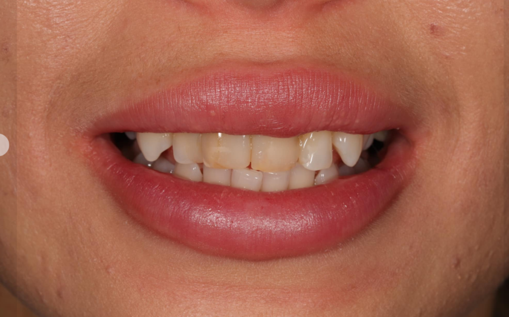 Циркониевые коронки