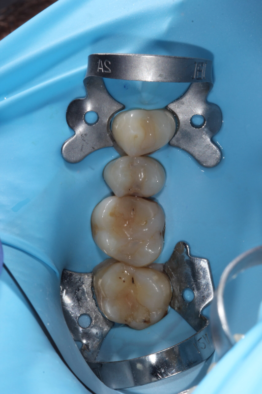 Лечение каналов