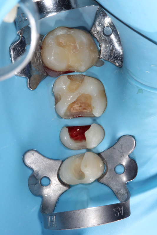 Лечение каналов