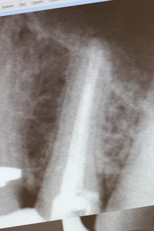 Лечение каналов