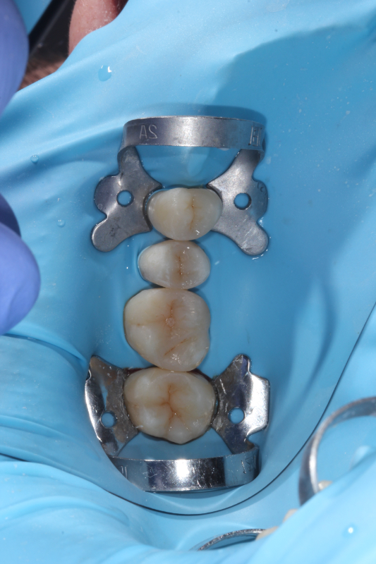 Лечение каналов